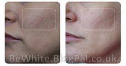 Facial whitening for Asian woman