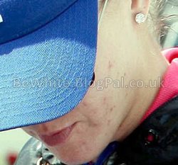 Best skin lightening for Zambian women