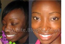 Best skin lighteners for Zimbabwean