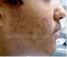 Asian whitening cream for Black Jamaican people