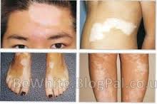 Facial whitening for Thai