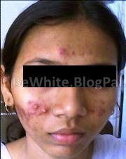 Face whitening cream for Malawi people