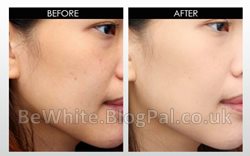 Uneven skin tone creams for Malawi people